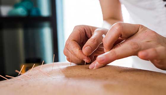 Things to Know About Acupuncture